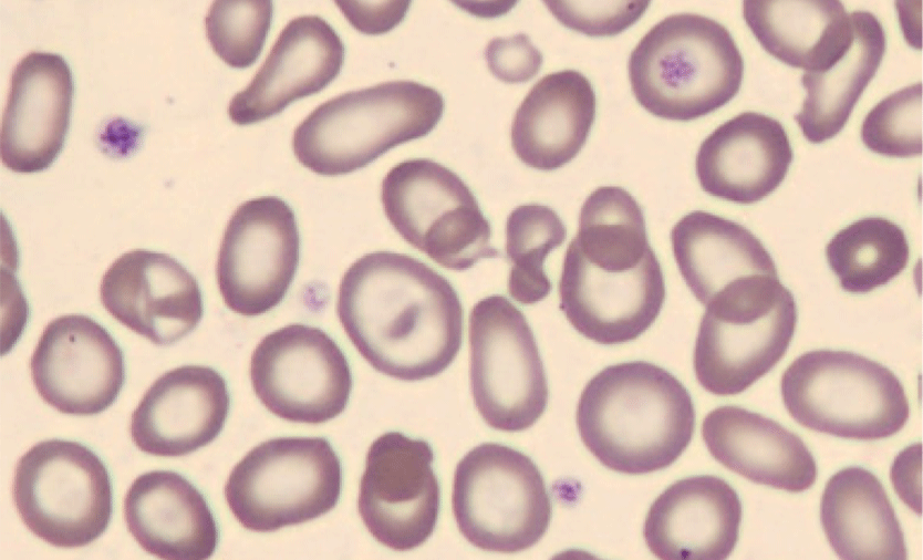anemia image