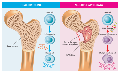 FC-measurable-residual-disease-in-mm-Image-1