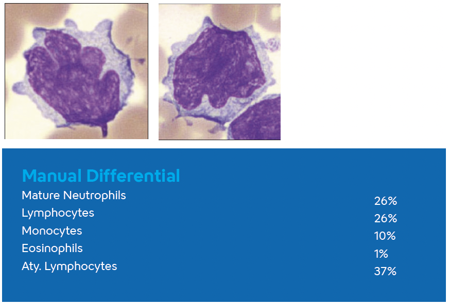 Hematology- Atypical Lympho- Image #2