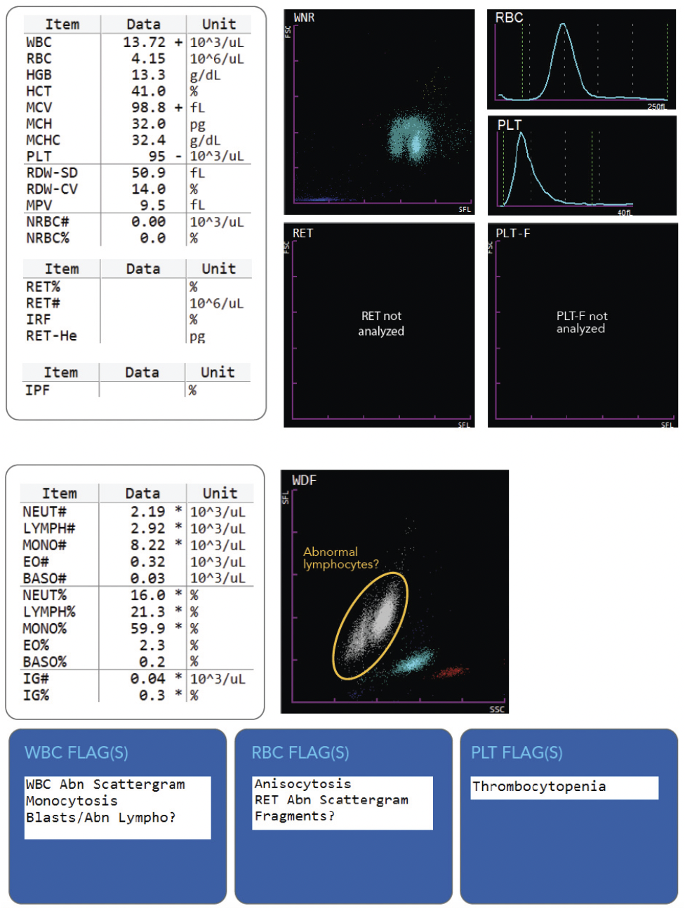 Hematology- Hairy Cell Leukemia- Image #1