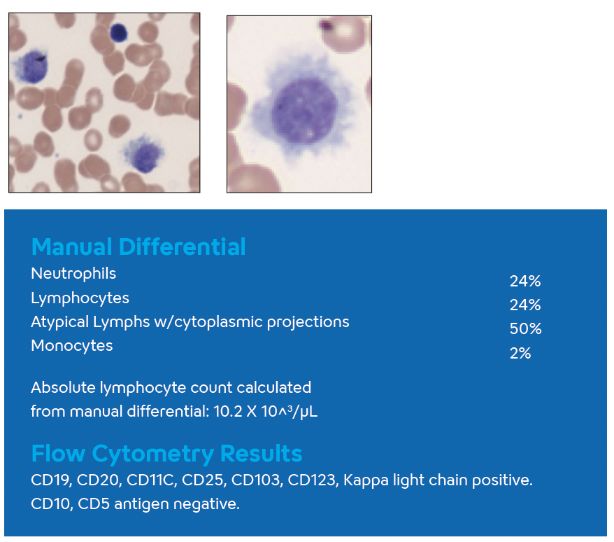 Hematology- Hairy Cell Leukemia- Image #2