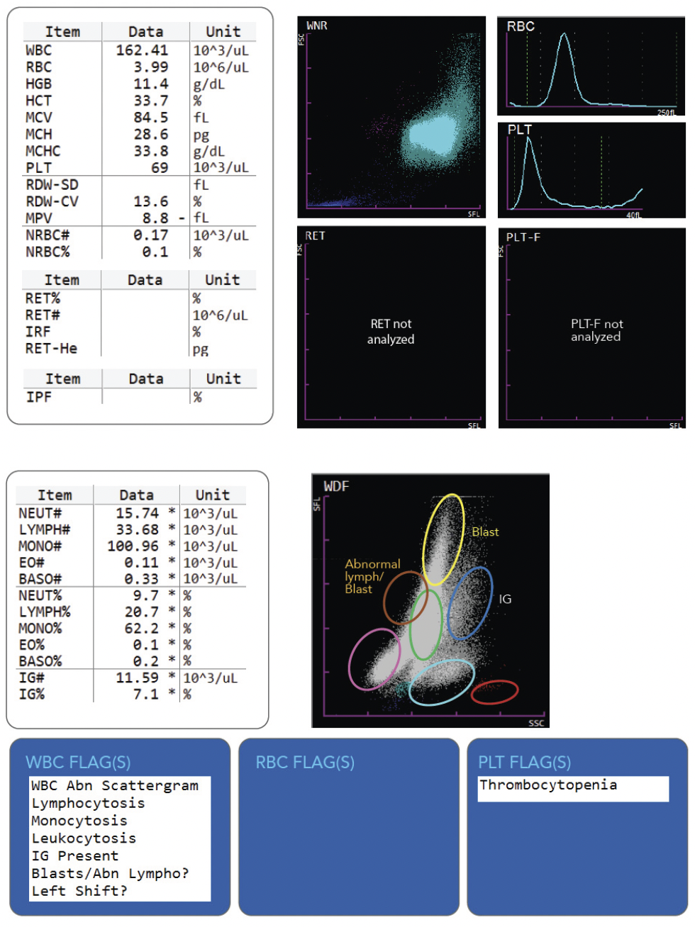 Hematology-High WBC Count with Blasts- Image #1