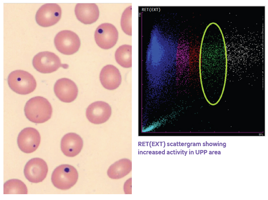 Hematology Howell-Jolly-Bodies image