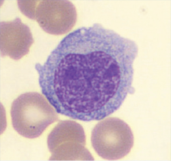 Hematology Case Study - Micromegakaryocytes Image #3