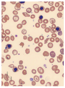 Hematology Case Study -Thalassemia Image #2