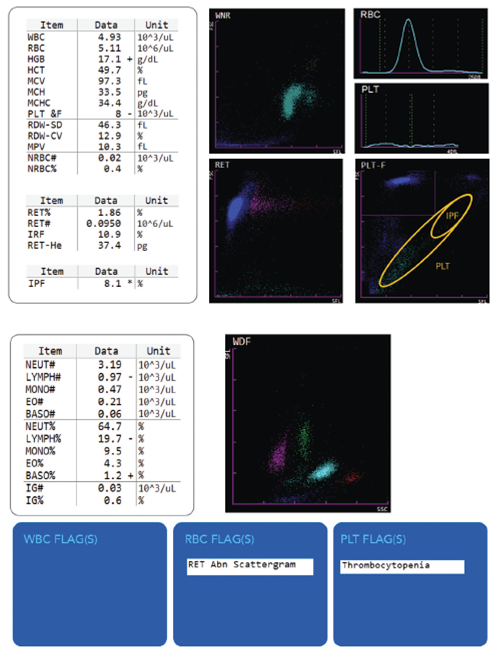 Hematology Case Study - Thrombocytopenia Image #1