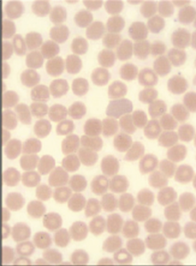 Hematology Case Study - Thrombocytopenia Image #2