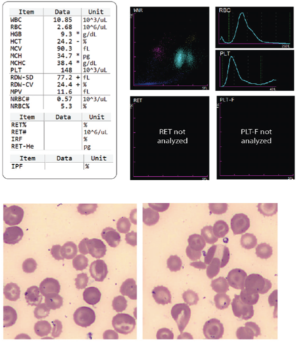 Hematology Hemoglobin C Disease Image and Scattergrams