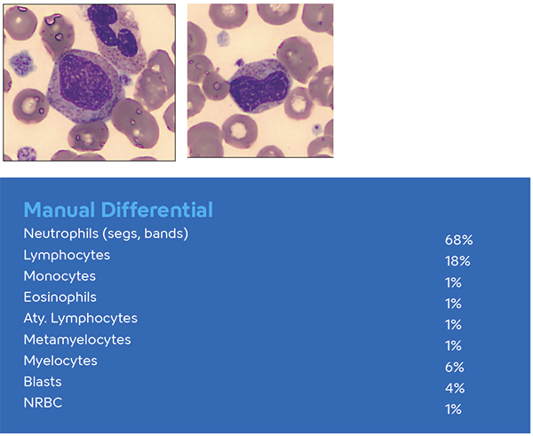 Hematology Immature Granulocytes image and manual differential