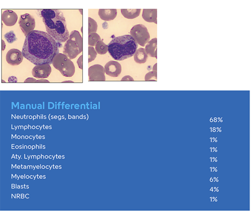 Hematology Immature Granulocytes image and manual differential