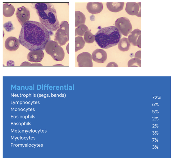 Hematology Immature Granulocytes image and Manual differential