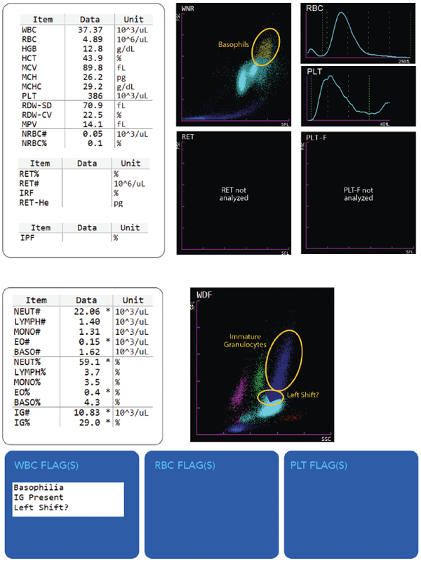 Hematology Immature Granulocytes Scattergram and results