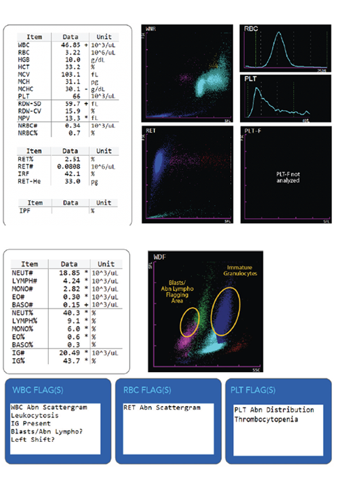Hematology Immature Granulocytes Scattergram Results and Flags