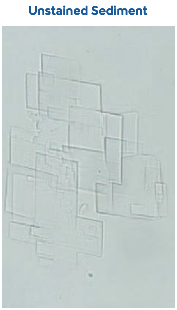 Urinalysis - Cholesterol Crystals- Image-1