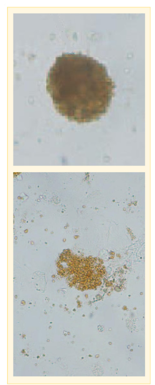 Urinalysis - Hemosiderin- Image-1