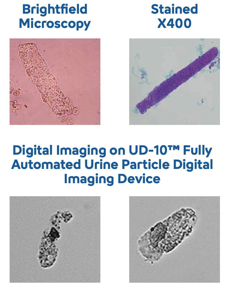 Urinalysis - What are granular casts - Image-1