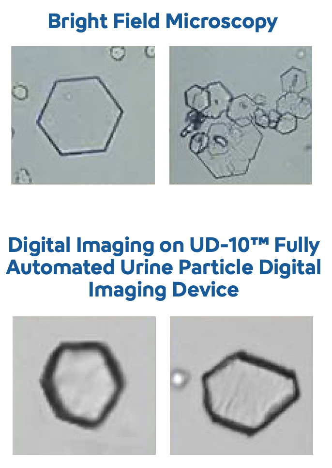 Urinalysis -Cystinuria- Image-1