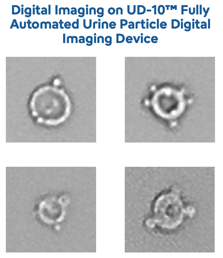 Urinalysis  Dismorphic RBCs -Image1