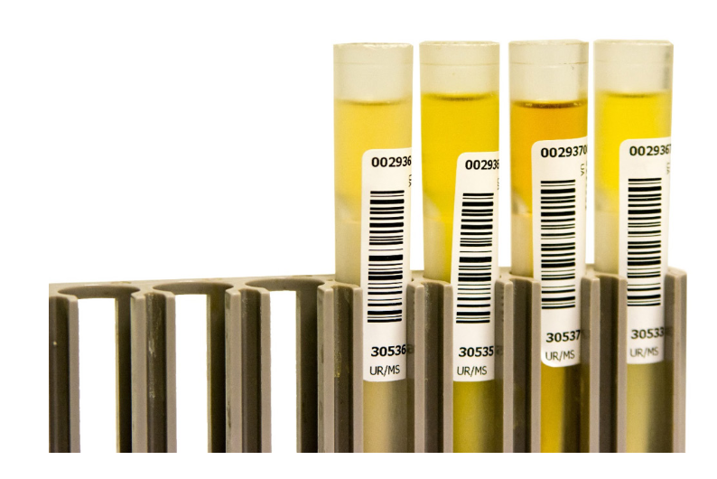 Urinalysis -Proteinuria- Image-1