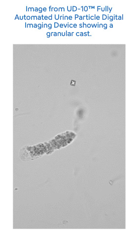 urinaysis - diabetic nephropathy