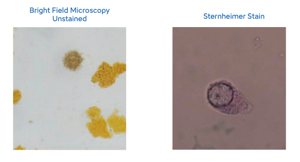 bilirubin crystals